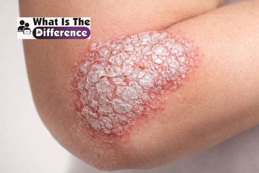 what is difference between eczema and psoriasis